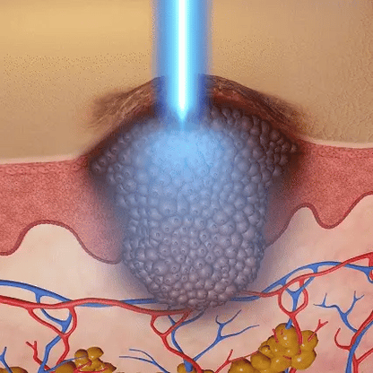 🔥 Erase Moles & Skin Tags in Days! ACEZOZLA™ Non-Invasive Laser Pen – Hospital-Grade, Safe & Painless ✨