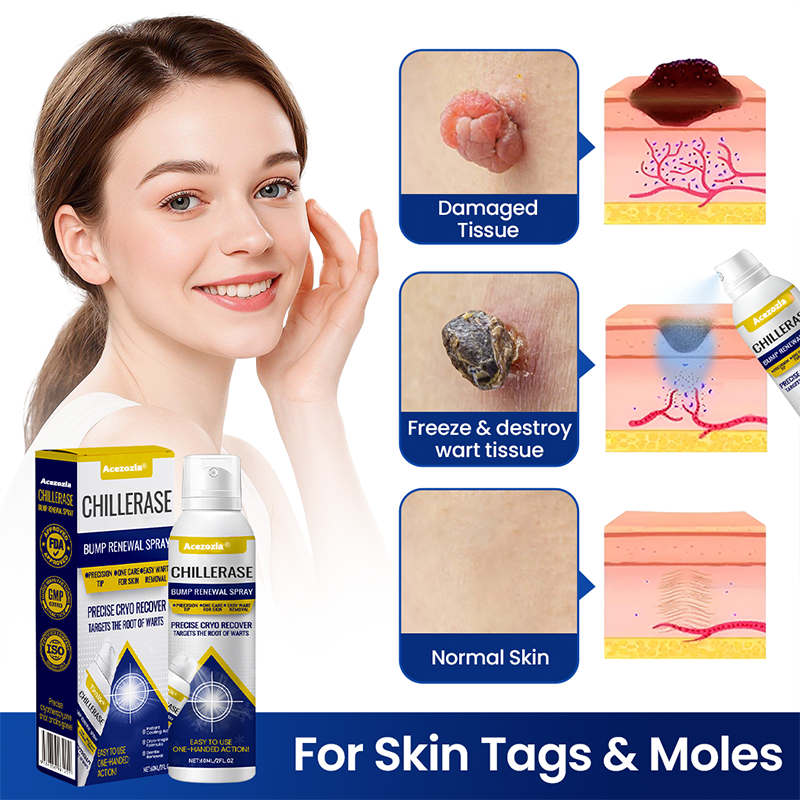 Acezozla® ChillErase Bump Renewal Spray