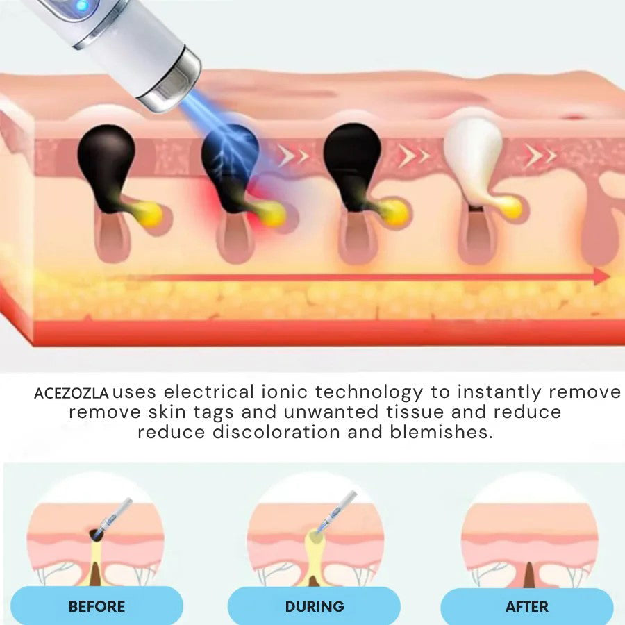 🔥 Erase Moles & Skin Tags in Days! ACEZOZLA™ Non-Invasive Laser Pen – Hospital-Grade, Safe & Painless ✨