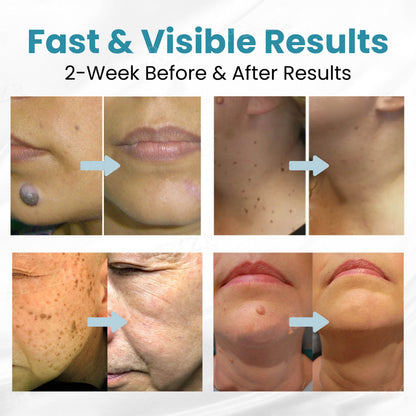 🔥 Erase Moles & Skin Tags in Days! ACEZOZLA™ Non-Invasive Laser Pen – Hospital-Grade, Safe & Painless ✨