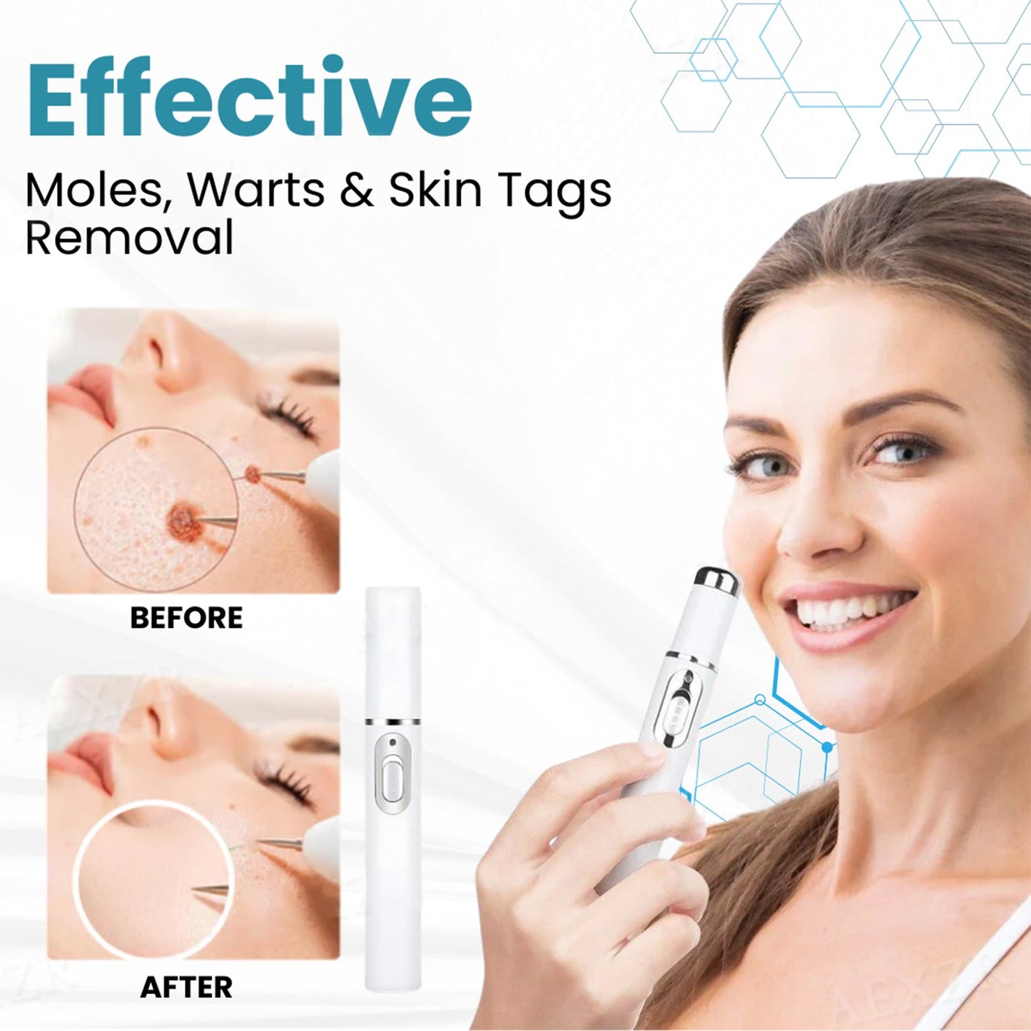 🔥 Erase Moles & Skin Tags in Days! ACEZOZLA™ Non-Invasive Laser Pen – Hospital-Grade, Safe & Painless ✨