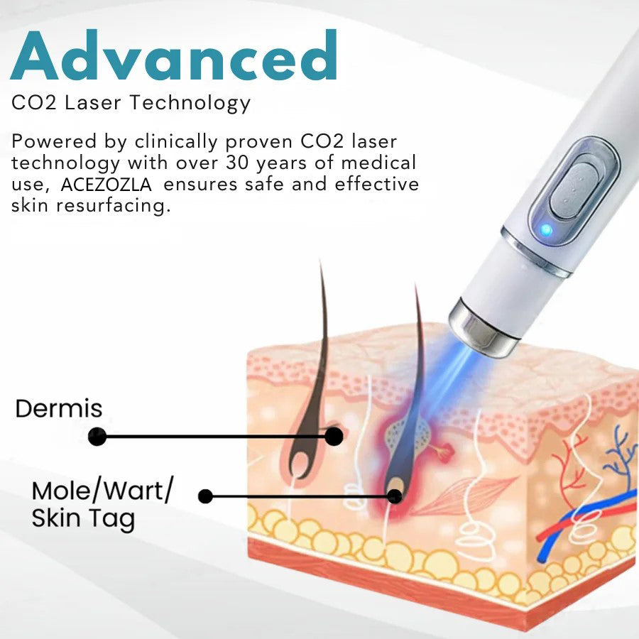 🔥 Erase Moles & Skin Tags in Days! ACEZOZLA™ Non-Invasive Laser Pen – Hospital-Grade, Safe & Painless ✨
